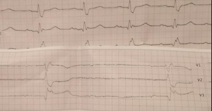 Сверху видна старая ЭКГ, снятая 7 января. Частота пульса нормальная, около 83 в минуту. Снизу свежая ЭКГ, снятая мной. Частота около 30 в минуту.