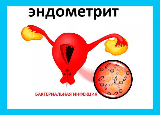 Воспаление внутренней оболочки матки. Воспаление эндометрия. Бактериальный эндометрит.