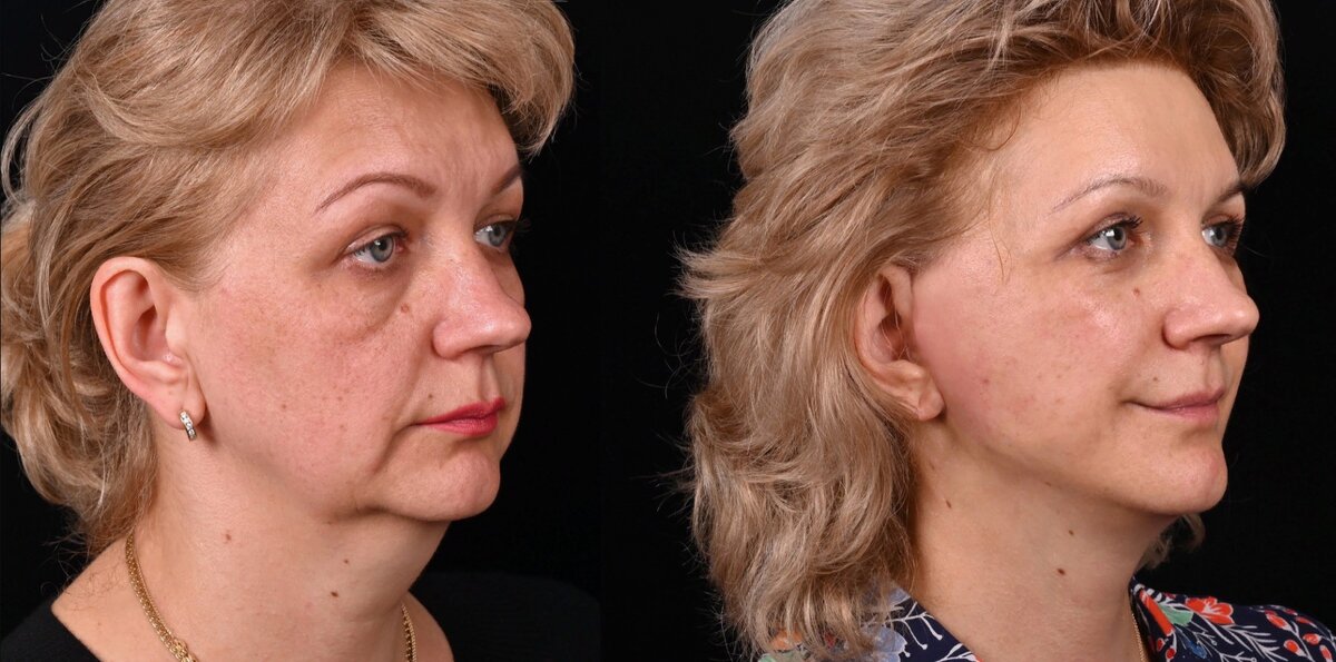 Круговая пластика лица и шеи и блефаропластика верхних век. Фото до и после. Фото с сайта хирурга Д.Р. Гришкяна. Имеются противопоказания, требуется консультация специалиста 