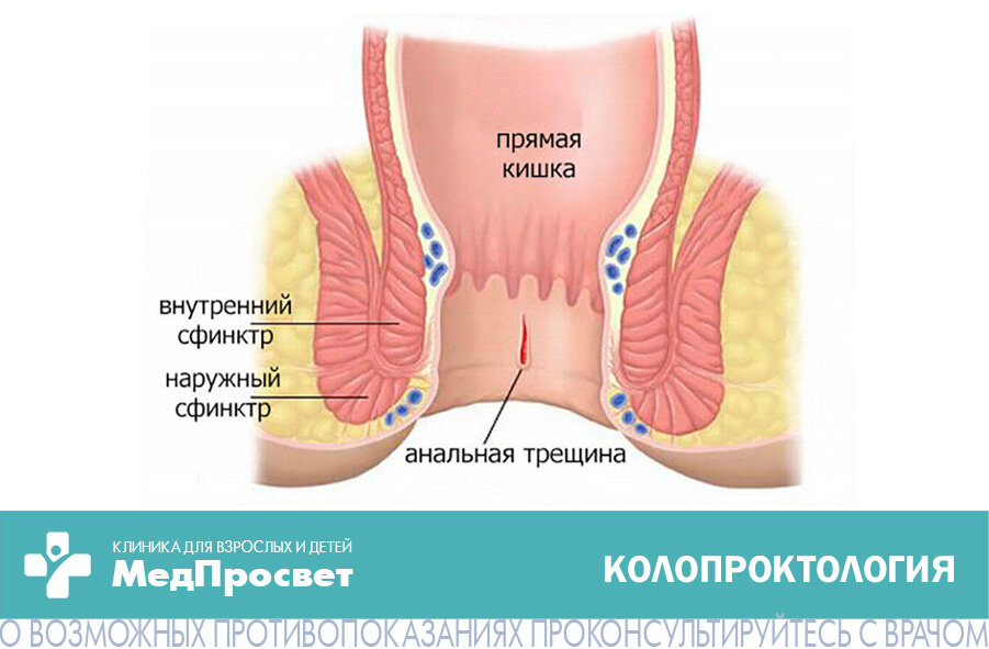 Лечение анальной трещины.