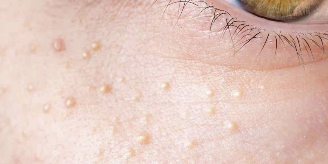 Милиумы или просянки. Как избавиться в домашних условиях?