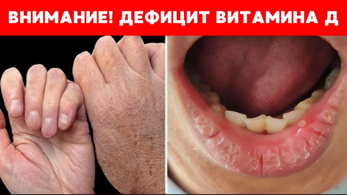 Дефицит витамина Д