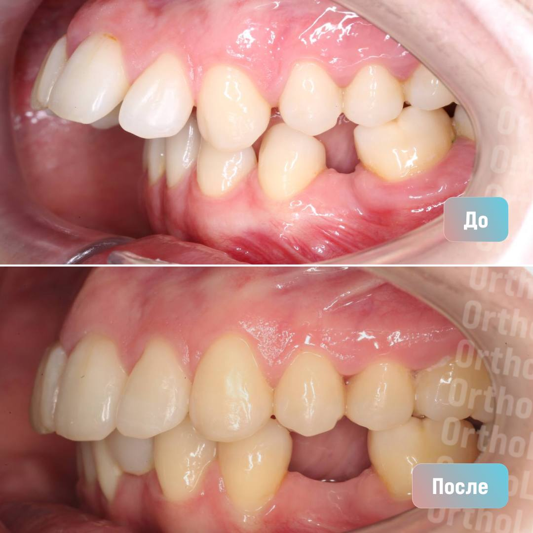 Лечение дистального прикуса: кейс врача-ортодонта OrthoLike Анны Пилипчук |  Андрей Жук эксперт по ортодонтии | Дзен