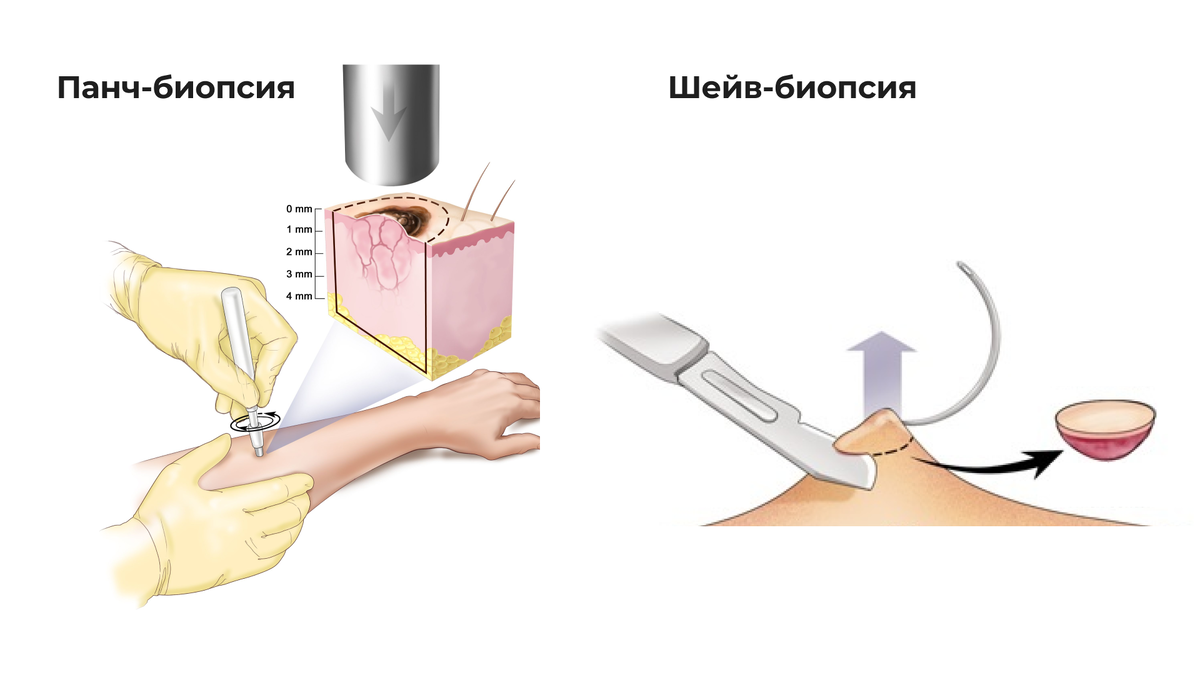 Когда нужна и как проводится биопсия кожи? | Дерматолог Ольга Антонова |  Дзен