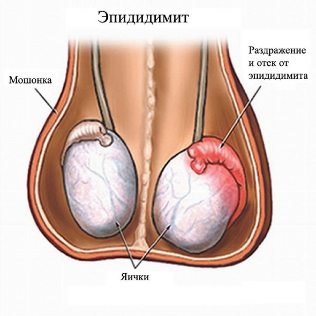 Воспаление придатка яичка – эпидидимит.. Гидроцеле киста семенного канатика. Ниже яиц у мужчин