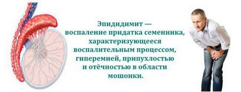 Эпидидимит воспаление придатка. Воспалённый придаток яичка. Воспаление придатка яичка – эпидидимит.. Воспаление придатков яичка.