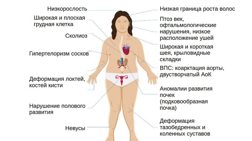 Синдром Шерешевского Тернера - причины, симптомы, диагностика и лечение