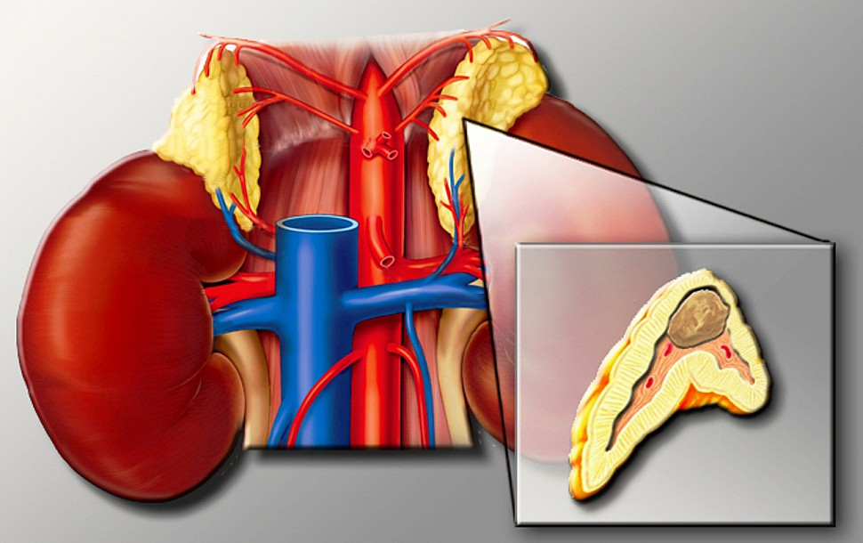 Надпочечник доброкачественный. Феохромоцитома надпочечника. Феохромоцитома надпочечника макропрепарат. Феохромоцитома Глюкоза.