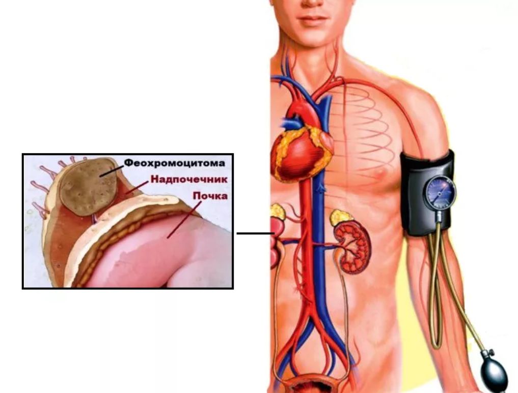 Надпочечники и давление. Симптомы феохромоцитомы надпочечников. Феохромоцитома, феохромобластома (опухоли надпочечников).. Пациентов с феохромоцитомой.