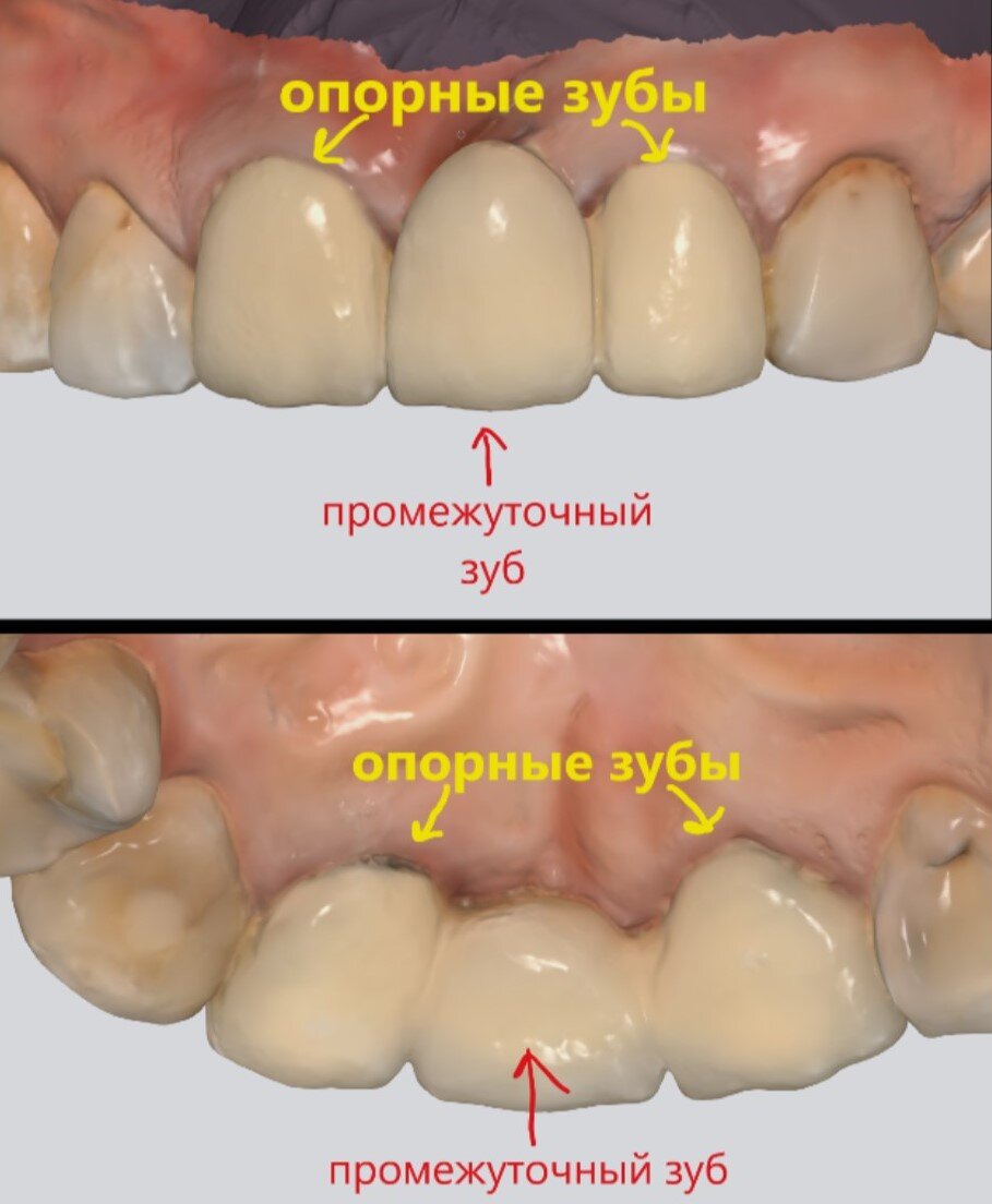 Мостовидный протез - восстановление зуба 2.1 - верхнего первого резца слева