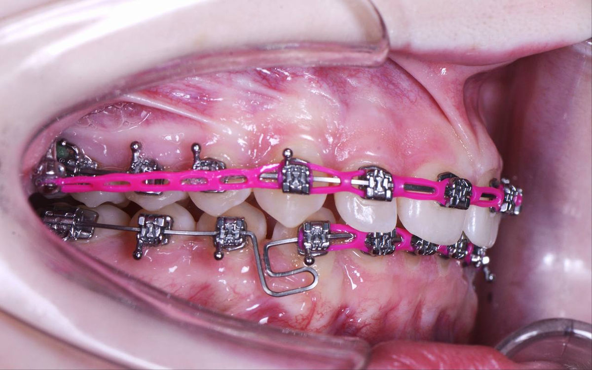 Виден чейн из розового силикона