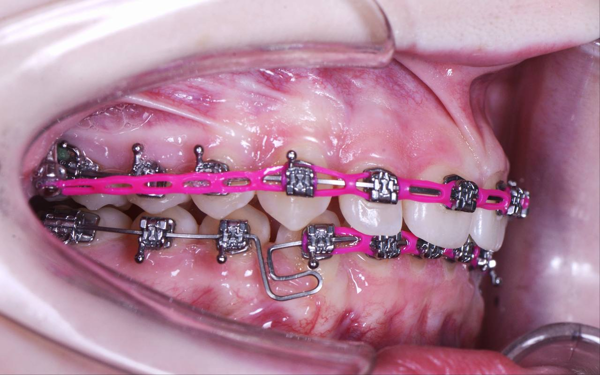 Резинки (эластики) для брекетов купить межчелюстные резиновые тяги