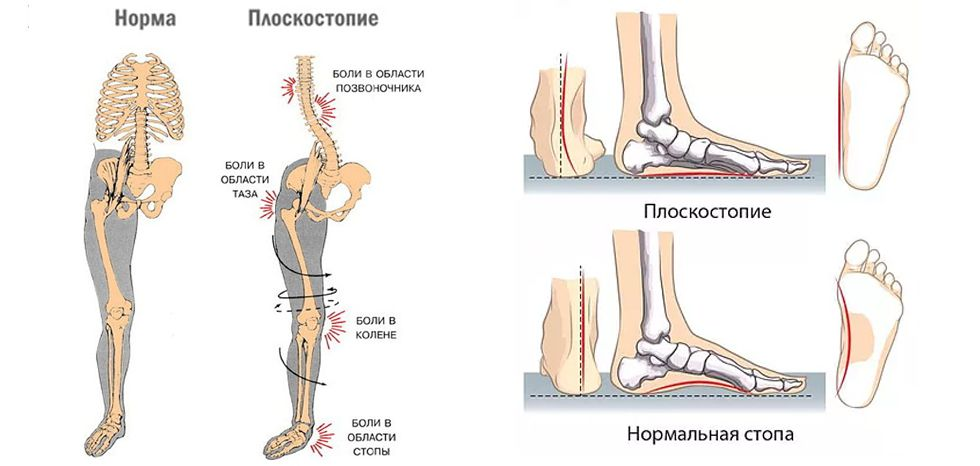 Продольное и поперечное плоскостопие - лечение, симптомы, причины, диагностика | Центр Дикуля