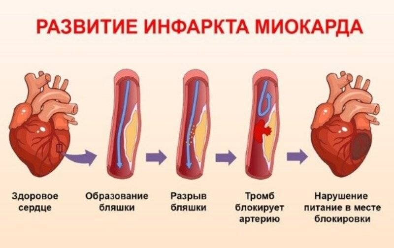 Все этапы инфаркта видны на этой картинке