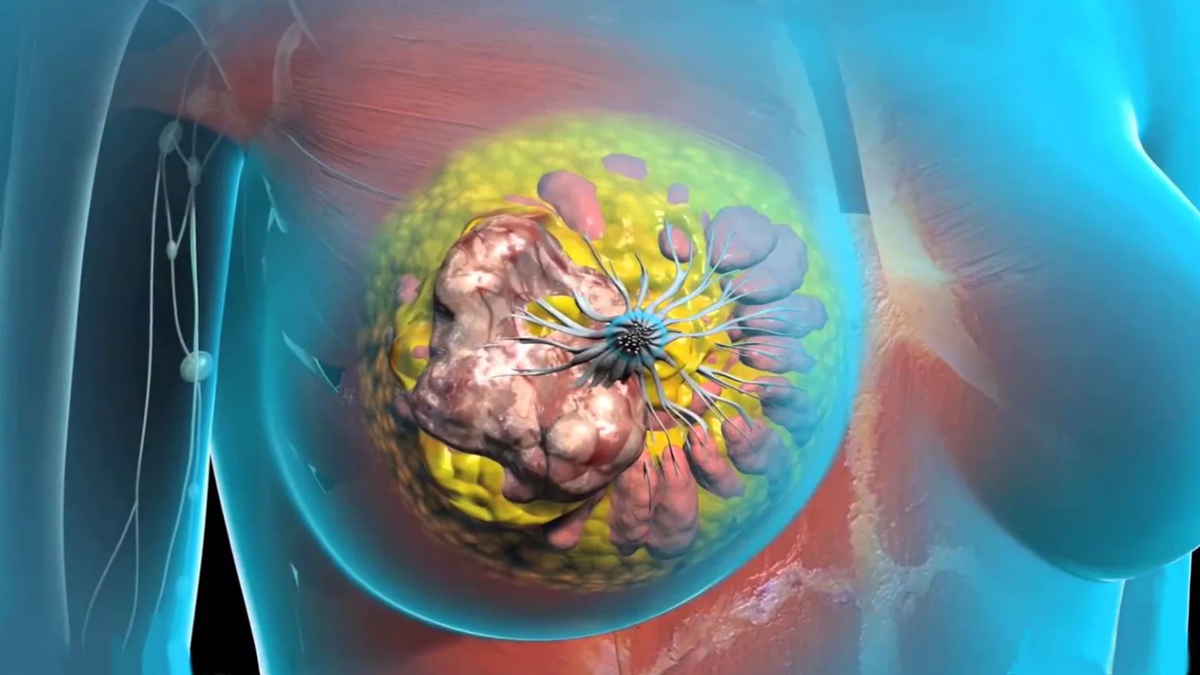 Как выглядит молочная железа при раке. Опухоль молочной железы. Злокачественное новообразование молочной железы. Онкологические заболевания груди.