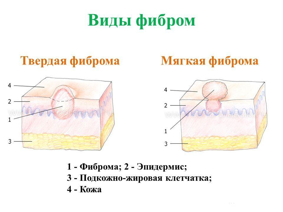 Десмоидная (опухоль) фиброма - симптомы, причины, диагностика и лечение в лучших клиниках