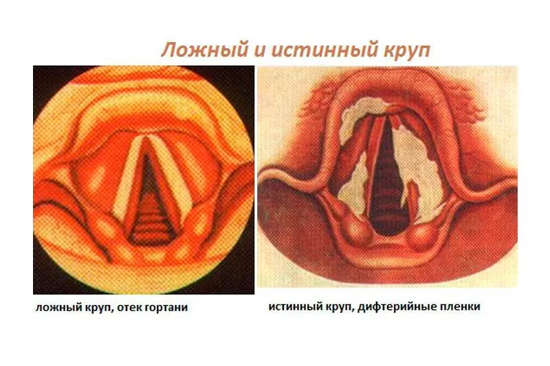 Ларингит: виды, причины, симптомы, диагностика и лечение у взрослых и детей | Лор-кабинет