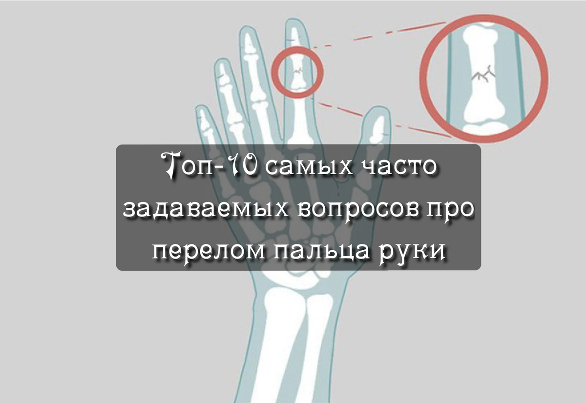 Топ 10 самых часто задаваемых вопросов про перелом пальца руки. | Просто о  сложном (советы хирурга, травматолога-ортопеда) | Дзен