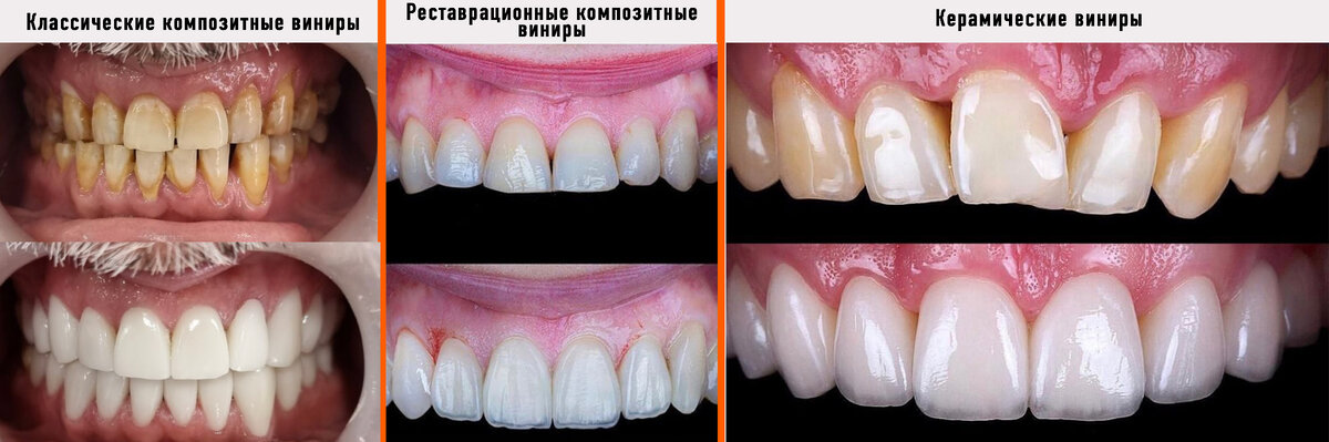 3 самых популярных вида виниров