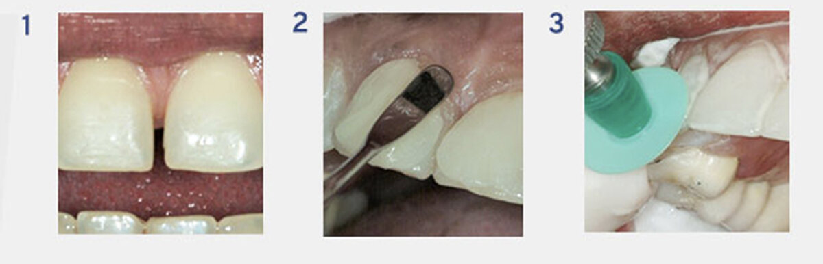 Создание классических композитных виниров