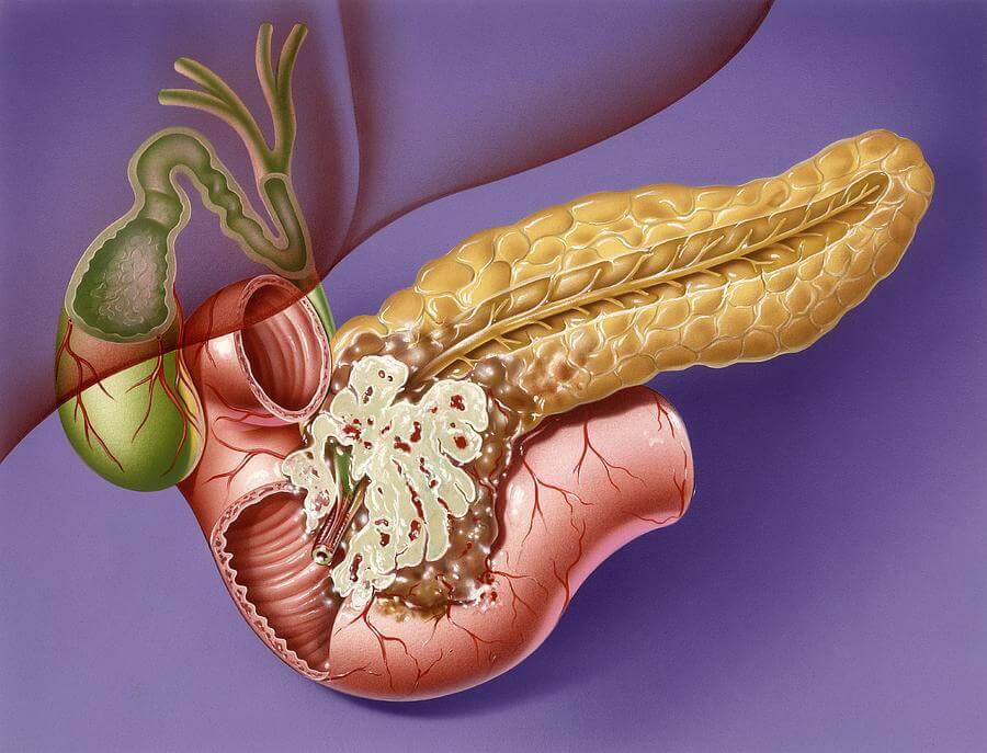Поджелудочная железа симптомы рака у мужчин. Аденокарцинома поджелудочной железы. Глюкагонома поджелудочной железы. Цистаденокарцинома поджелудочной. Тумор поджелудочной железы.