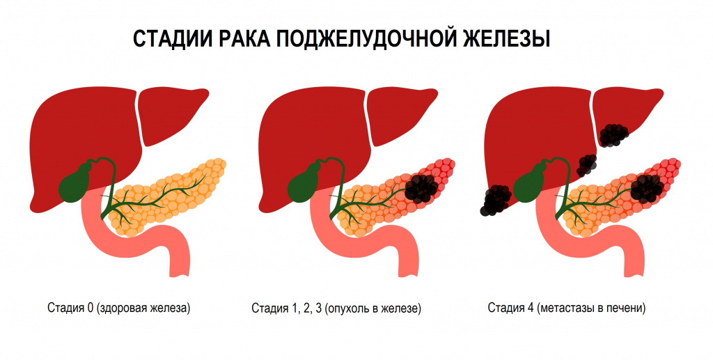 Рак хвоста поджелудочной. Стадии онкологии поджелудочной железы. Протоковая карцинома поджелудочной железы. Злокачественный поджелудочной железы.