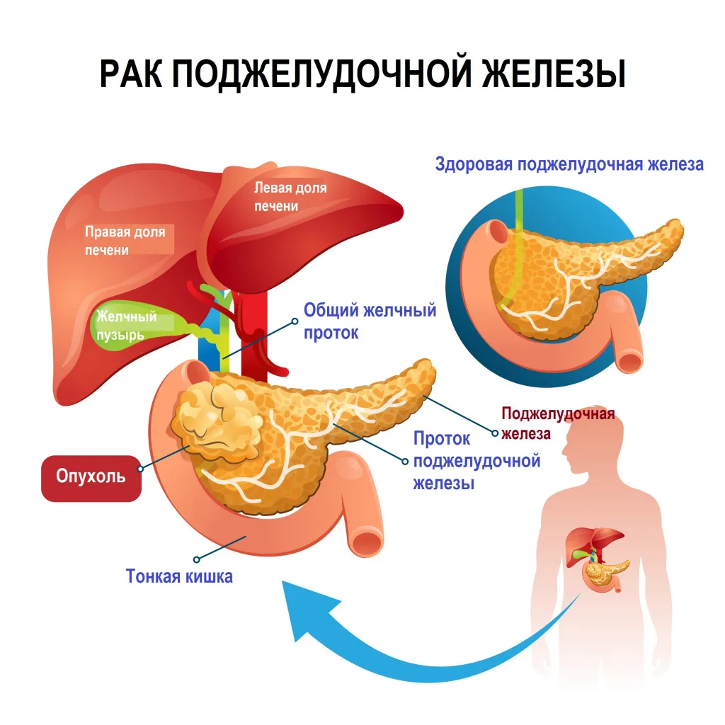 Рак поджелудочной признаки и симптомы