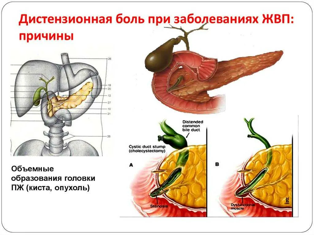 дискинезия протоков. дискинезия жёлчного пузыря и желчевыводящих путей. симптомы дискинезии желчного пузыря. дискинезия желчных протоков. принципы дифференцированной терапии джвп.