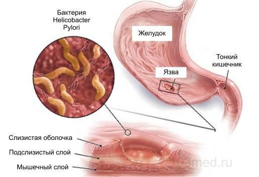 Бактерия Хеликобактер пилори и желудок