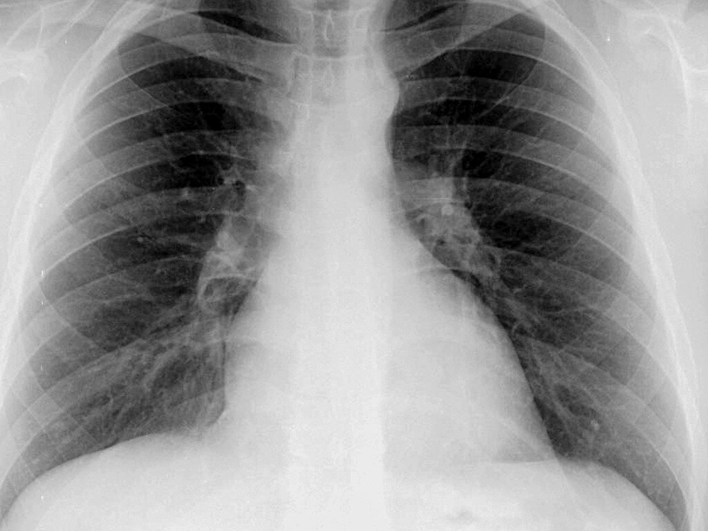 Это - нормальная рентгенограмма лёгких у ребёнка... Яндекс-фото