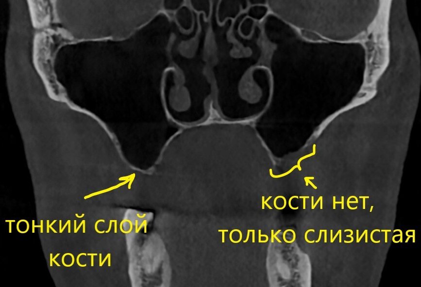 Анатомическая структура образующая стенку почечной пазухи