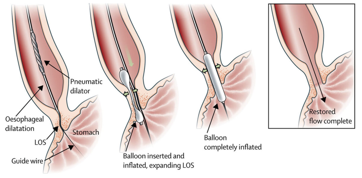 Сфинктер пищевода лечение. Ахалазия пищевода кардиодилатация. Ахалазия кардии баллонная дилатация. Пневмокардиодилатация при ахалазии кардии. Пневмокардиодилатация при ахалазии.