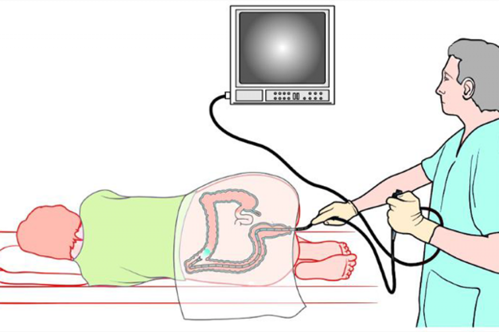 Фгдс ирригоскопия. Эндоскопическое исследование толстой кишки колоноскопия. Схема проведения колоноскопии. Прибор для проведения колоноскопии кишечника. Колоноскопия фиброколоноскопия.