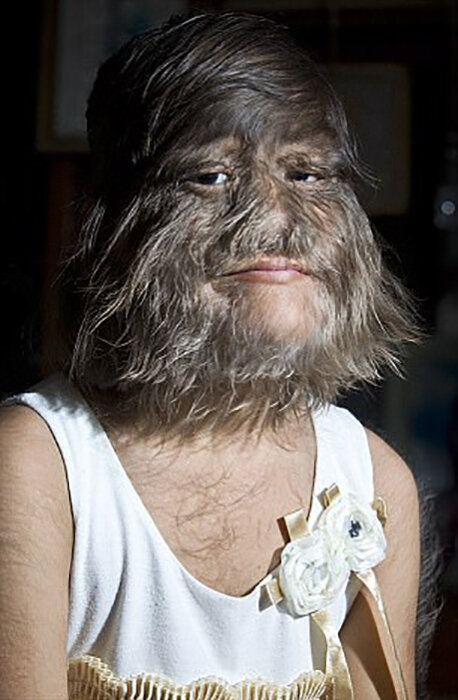  17-летняя Супатра страдает синдромом Амбраса.