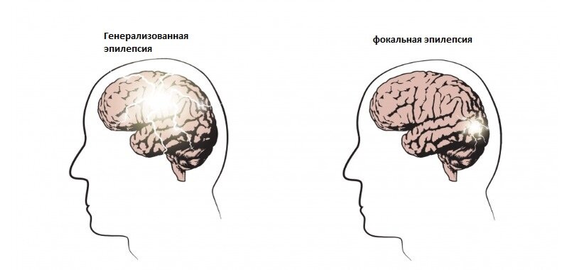 Откуда берется эпилепсия и как ее избежать