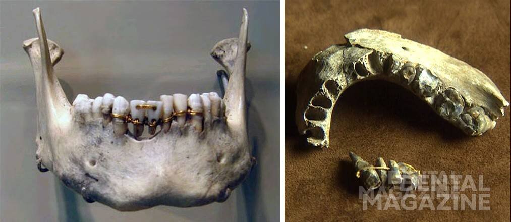 Имплантаты этрусков. Фото взяты с сайта https://dentalmagazine.ru/
