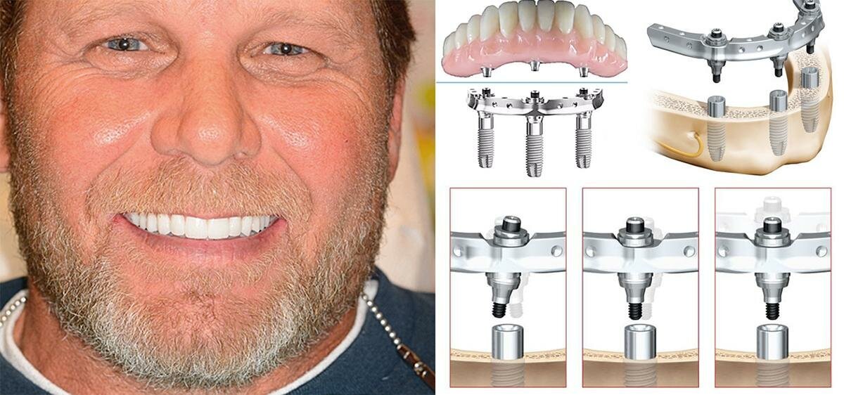 Имплант зуба за день. Зубные протезы на имплантах. Титановые протезы.