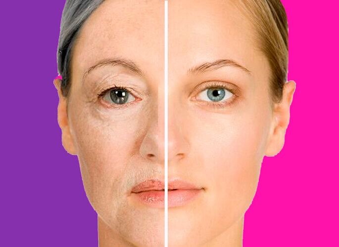 SMAS-лифтинг лица