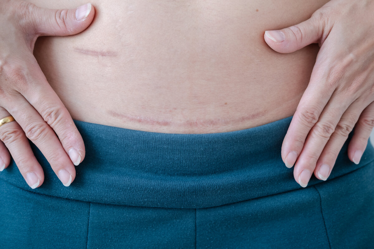 Растяжки могут быть причиной беспокойства