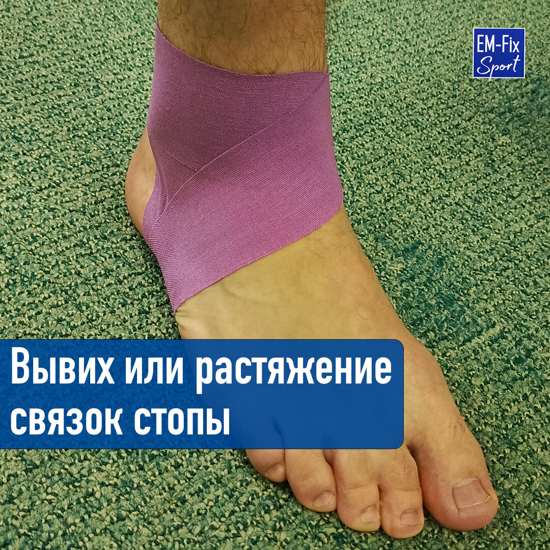 Как лечить растяжение связок на ноге. Как лечить растяжение связок на ноге