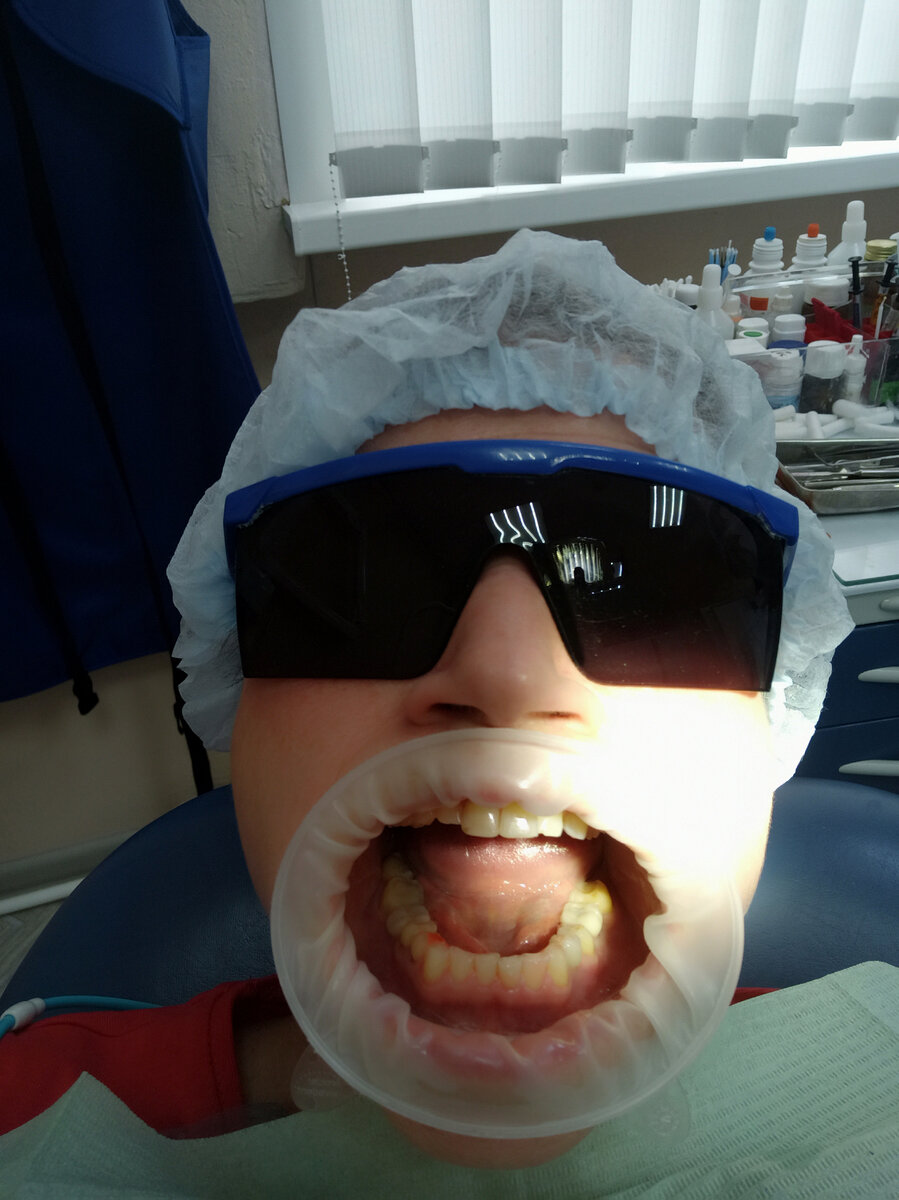 Выдали ШАПОЧКУ И ОЧКИ. Нанесли анестетик на дёсны перед профчисткой. Он такой ,,вкусный",как Juicu Fruit.😀. Ждём две минуты...