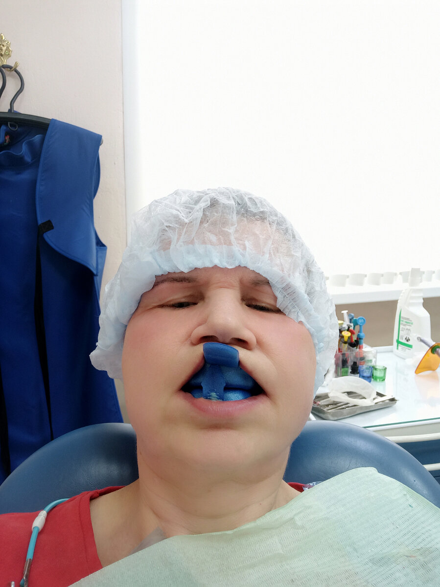 А это тоже Я🤣: после профчистки заменили шатающуюся пломбу и сделали аппликацию со фтором.