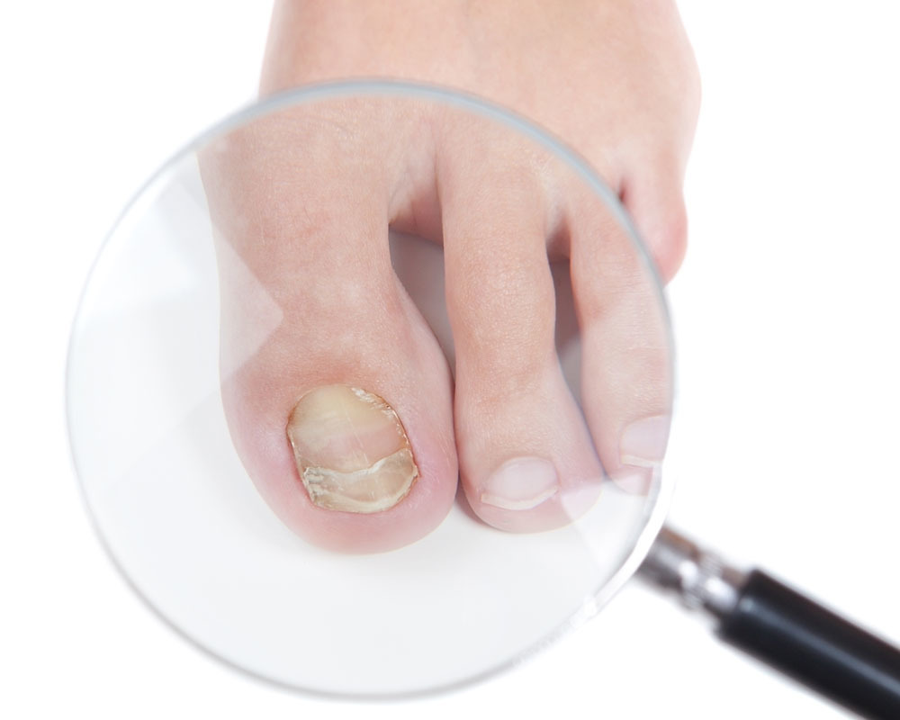 Если ногти стали желтеть, они трескаются, крошатся, а кожа шелушится – скорее всего, у вас грибковое поражение ногтей. Это инфекционное заболевание, вызванное особым патогенным грибком.