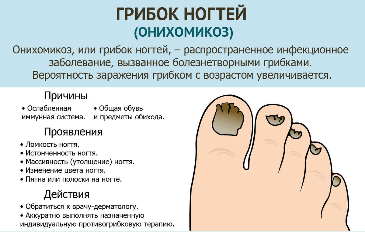 Грибковые заболевания ногтей схема. Онихомикоз — грибковое поражение ногтей.. Грибковые заболевания ногтей на ногах. Можно избавиться от грибка ногтей
