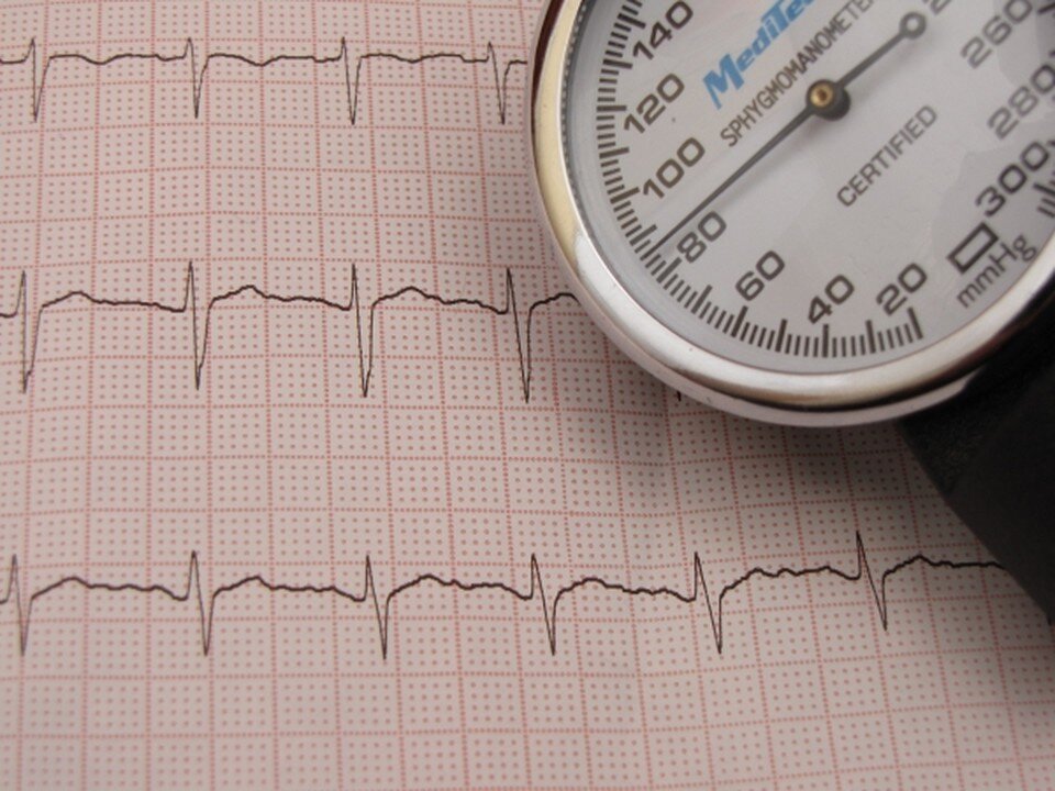    Оказалось, что больной - гипертоник, но за давлением не следил и таблетки не принимал. РАСЮК Татьяна Витальевна