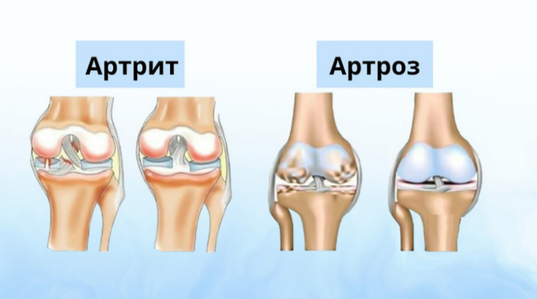 Отличия артрита и артроза: как понять, что беспокоит ваш сустав?