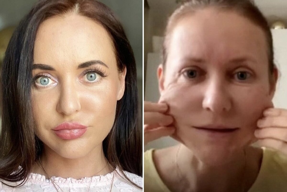 Та самая Светлана - до и после лонгидазы