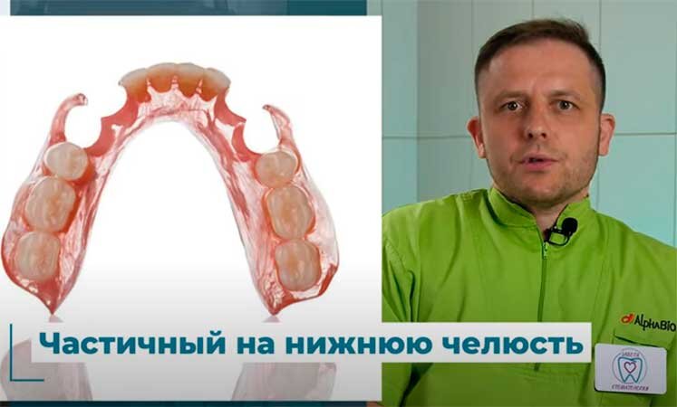 Частичный на нижнюю челюсть 