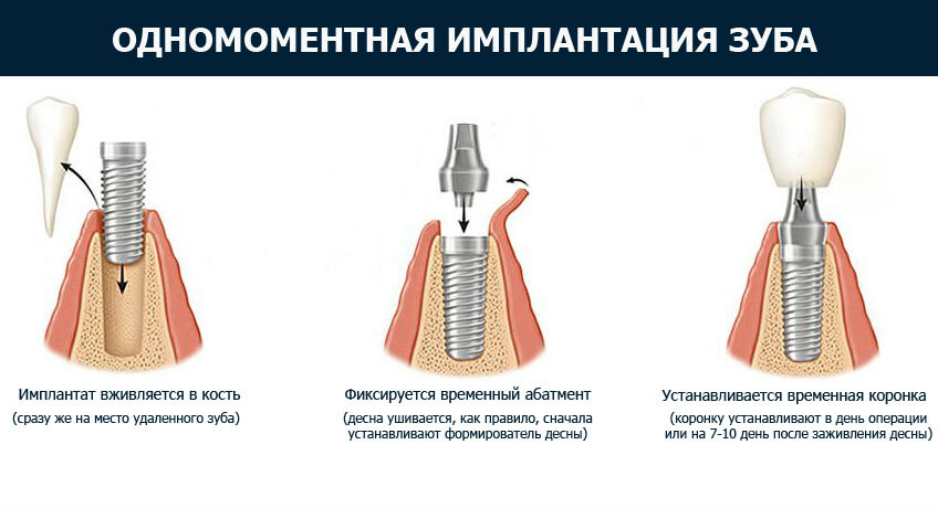 Сода после удаление зуба