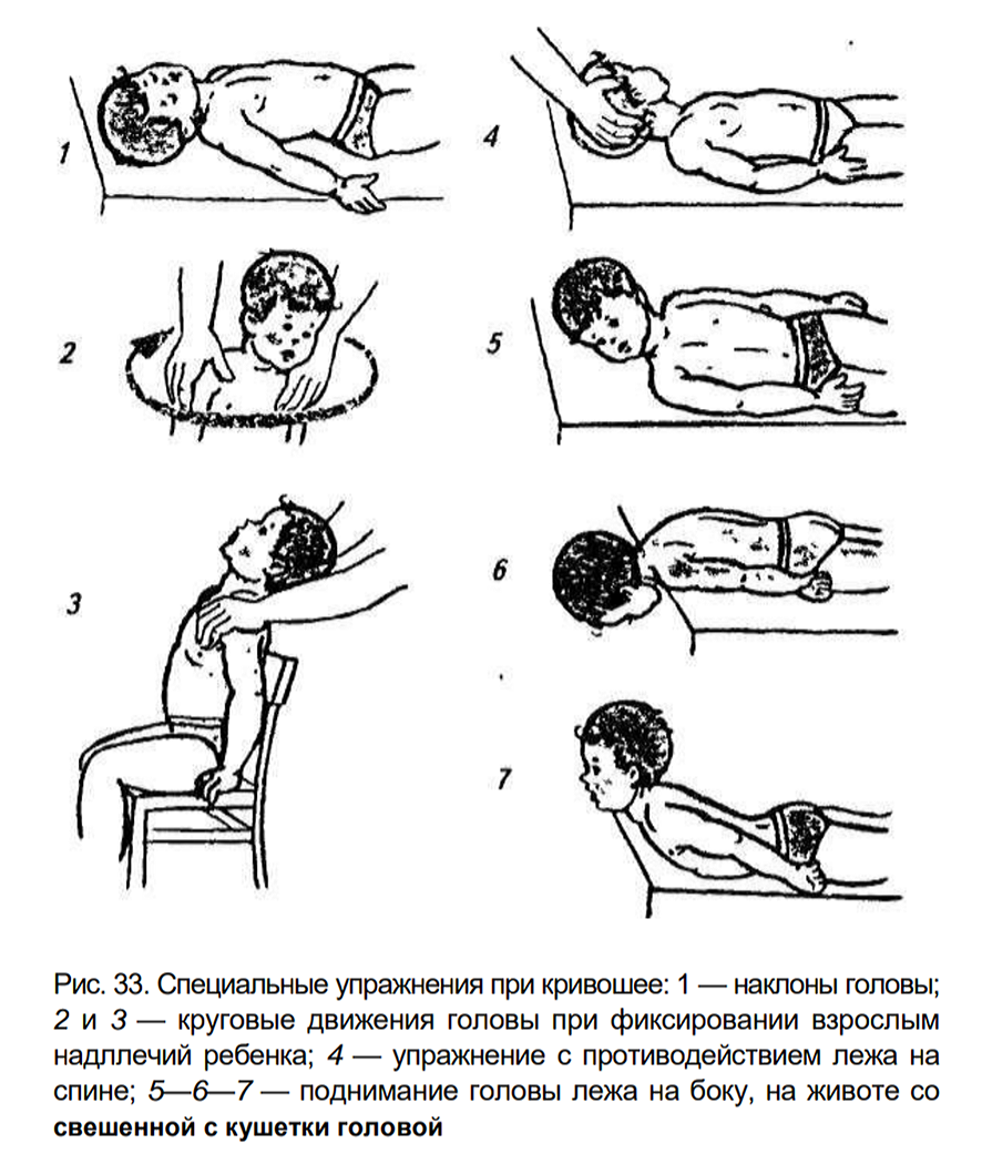 Кривошея гимнастика